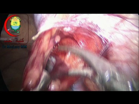 Varicocelectomía laparoscópica con preservación de la arteria