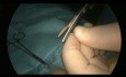 Reparación laparoscópica percutánea de hernia inguinal
