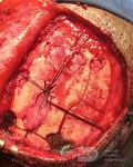 Planificación quirúrgica con neuronavegador en paciente con lesión de masa intracraneal. Glioma de alto grado.