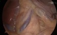 Durchtrennung des Ligamentum arcuatum