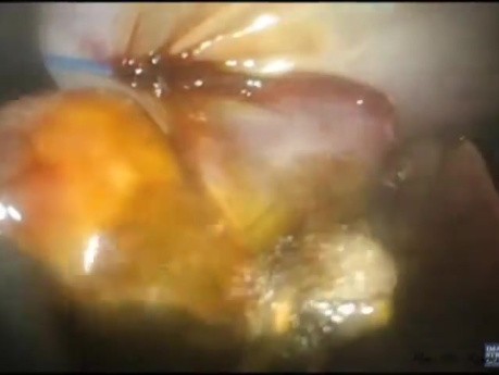 Evolución de la colecistectomía laparoendoscópica de sitio único (LESS) sin anestesia general