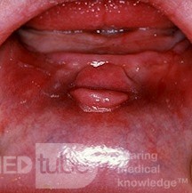 Granuloma de la dentadura