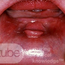 Granuloma de la dentadura