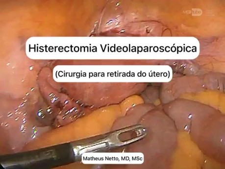 Histerectomía total laparoscópica [video corto]