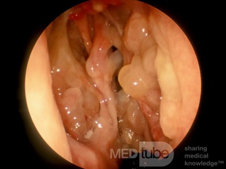 Pólipos nasales recurrentes