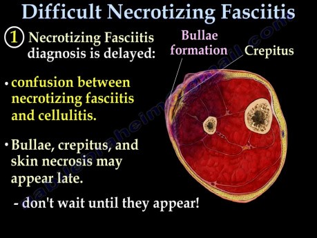 Fascitis necrotizante - casos complicados - Parte 2