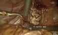 Histerectomía total laparoscópica con endometriosis rectovaginal