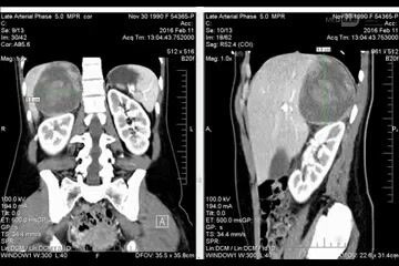 Adrenalectomía laparoscópica de un tumor enorme