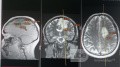 Planificación quirúrgica con neuronavegador en paciente con lesión de masa intracraneal. Glioma de alto grado.