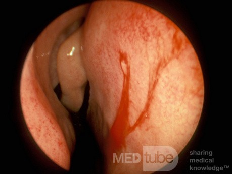 Vasos sanguíneos grandes del tabique nasal anterior