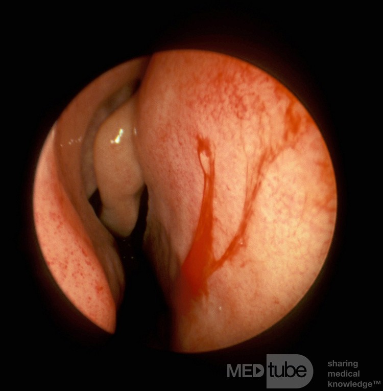 Vasos sanguíneos grandes del tabique nasal anterior