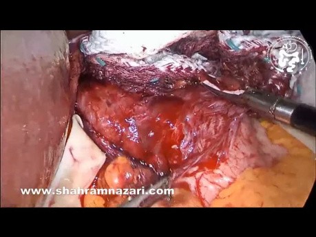 Perforación laparoscópica de la miotomía de Heller de la UEG tratada mediante sutura con almohadilla grasa de Belsey