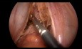 Rectopexia posterior laparoscópica para el prolapso rectal