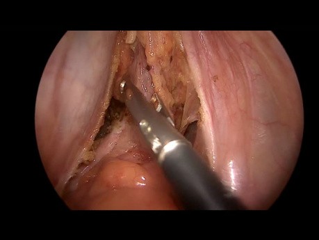 Rectopexia posterior laparoscópica para el prolapso rectal