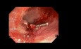 Polipectomía colónica con clips