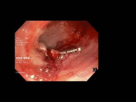 Polipectomía colónica con clips