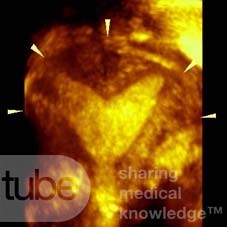 Útero septo parcial en ecografía tridimensional