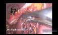 Colecistectomía laparoscópica de vesícula biliar contraída