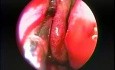 Antrostomía intranasal del seno maxilar - endoscopia