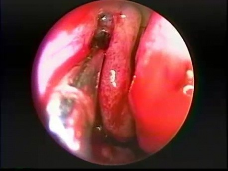 Antrostomía intranasal del seno maxilar - endoscopia