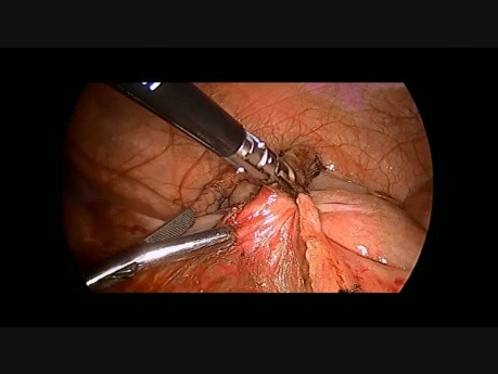 Apendicectomía laparoscópica    
