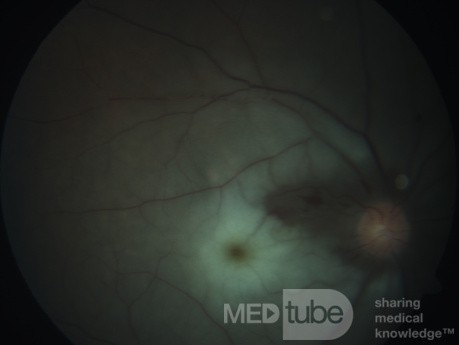 Oclusión de la arteria central de la retina con preservación de la rama retiniana de cilio