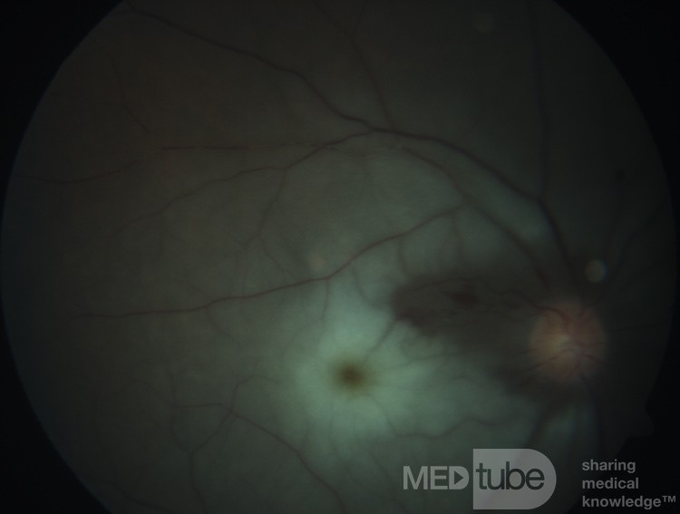 Oclusión de la arteria central de la retina con preservación de la rama retiniana de cilio