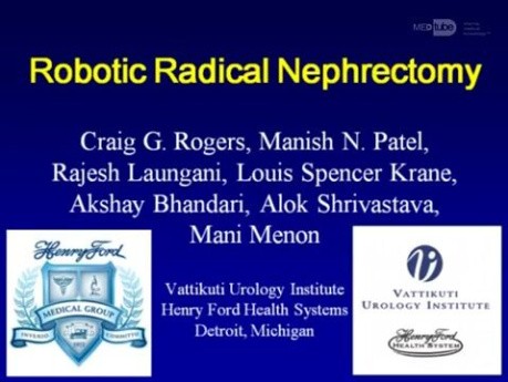Nefrectomía radical asistida por robot por causa de cáncer renal.