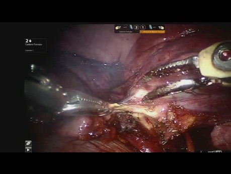 Lesión en la arteria pulmonar durante la lobectomía inferior izquierda - Accidente vascular