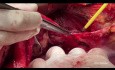 Aspectos técnicos de los procedimientos abdominales superiores en la cirugía del cáncer de ovario avanzado
