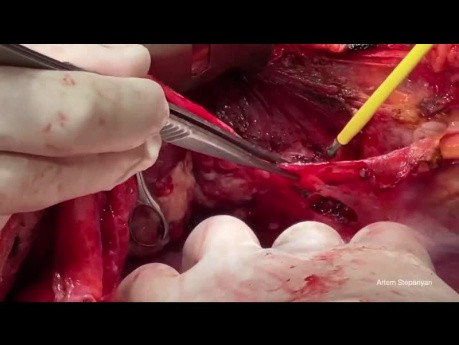 Aspectos técnicos de los procedimientos abdominales superiores en la cirugía del cáncer de ovario avanzado