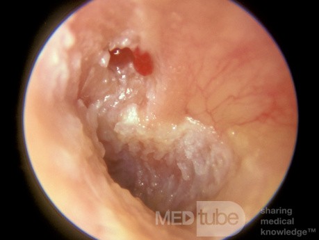 Colesteatoma de ático