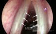 Sulcus Vocalis Bilateral