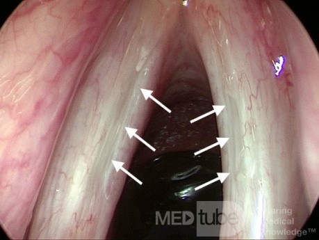 Sulcus Vocalis Bilateral