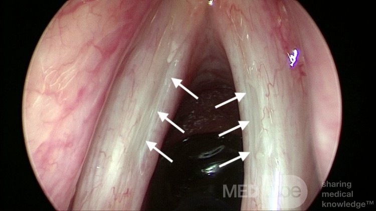 Sulcus Vocalis Bilateral