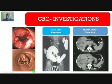 Cáncer de colon - hemorragia digestiva baja