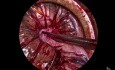 Morcelación vaginal para fibromas uterinos grandes