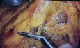 Duodenopancreatectomia cefalica laparoscopica (Whipple)