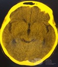 Tercera ventriculostomía endoscópica en un caso benigno de síndrome de Aicardi con hidrocefalia obstructiva y malformación de Chiari tipo 1