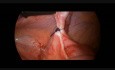 Reducción laparoscópica de intususcepción en niño de 5 años