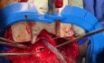Reparación de fístula traqueoesofágica