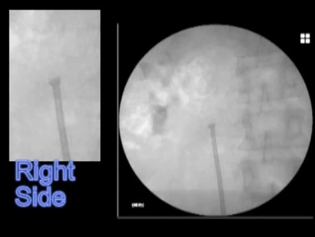 Colocación de stent ureteral