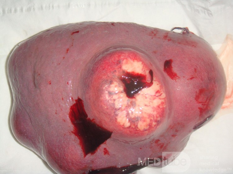 Linfoma no Hodgkin del bazo