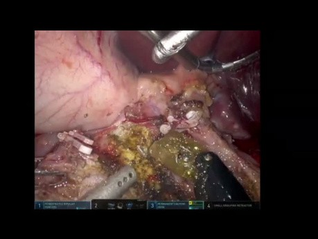 SSAT 2023 - Pancreaticoduodenectomía robótica para pancreatitis crónica con extracción de cálculos del conducto pancreático principal (CPP)