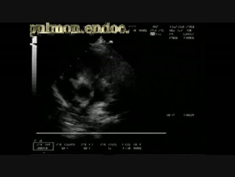 Endocarditis infecciosa: vegetación en la válvula pulmonar