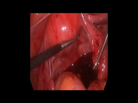 Hemoperitoneo Gestacion Ectopica Laparoscopia