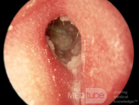 Otitis externa hipertrófica crónica