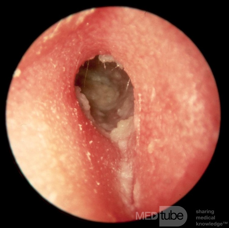 Otitis externa hipertrófica crónica