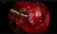 Tumor sinusal - sarcoma en la fosa pterigopalatina (4K)