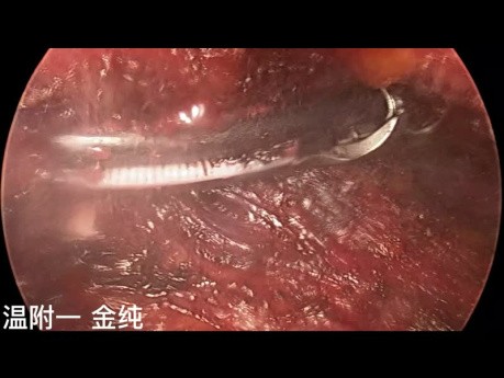 Cirugía endoscópica de tiroides transsubclavia de doble puerto (parte 2)